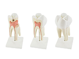 أجزاء الأسنان المكبرة |  تصنيع سن كبير الحجم له أجزاء قابلة للفصل، و بذلك يكون مثاليا للشرح للتلاميذ كيف تتشكل التجاويف والتسوس وعواقب عادات نظافة الأسنان السيئة .
